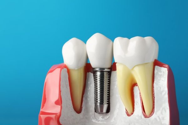 How To Get Dental Implants: Step-By-Step Guide