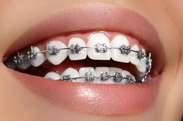 10 Easy Tips For Getting The Most Out Of Invisalign